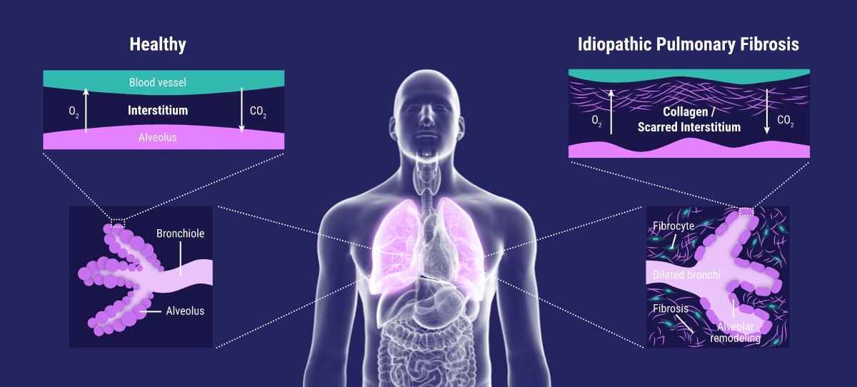 idiopathic pulmonary fibrosis diagram